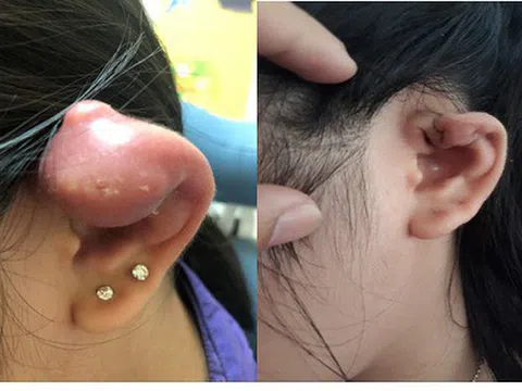 Bé gái 12 tuổi bị nổi u mủ sau khi bấm lỗ tai